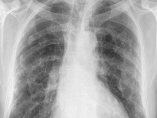 FIBROZA PULMONARA